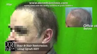 80&rsquo;s Hair Restoration Mistakes, Now a Thing of the Past for this Thankful Man