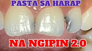 PASTA SA HARAP NA NGIPIN (2.0) 🦷