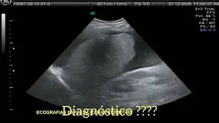 Ultrasonido de abdomen superior.Tipoca cirrosis hep&aacute;tica con ascitis 