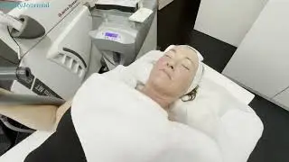 Zo mooi wordt je huid na laserbehandeling! Debbie kreeg Erbium Yag laser bij Waterland Kliniek