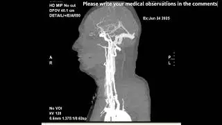 Computer Tomography (CT) cerebral vertical plane with contrast