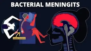 Bacterial Meningitis & Other CNS Infections | Pathology II Explained | Nervous System Disorders---
