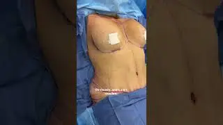 Tummy tuck and breast augmentation - Before and immediately after