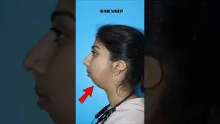 TMJ Joint Replacement & Gap Arthroplasty Explained | Jaw Surgery for Pain & Sleep Apnea