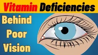 TOP 7 Vitamin Deficiencies Behind Eye Diseases and Poor Vision