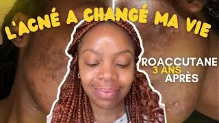 3 ans après le Roaccutane : l'acné a changé ma vie (s'aimer; confiance en soi, dépression) #acne