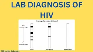 LABORATORY DIAGNOSIS OF HIV INFECTION | AIDS | WESTERN BLOT