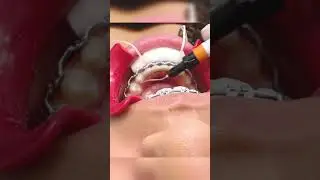 Bonding a fixed &ldquo;permanent&rdquo; retainer