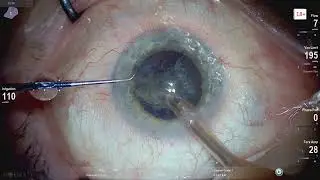 Ophthalmic surgery live 18+ Lukan Mishev