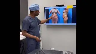 Pre Op discussion for  revision liposuction surgery