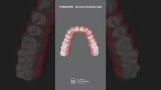 JAK DZIAŁA INVISALIGN? | Klinika Wieczorek