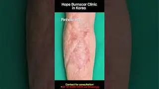Burnscar on arm #burn #burnscar #lasertherapy #laser #burnscars #scarremoval #scartreatment #scar