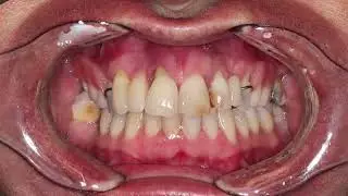 All On X | Teeth In A Day Case 12 | Pinnacle Oral Surgery
