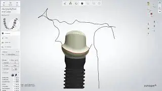 3Shape 덴탈시스템 - 어버트먼트 및 크라운 디자인 - 3Shape Dental System - Abutment and Crown Design