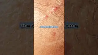 How we Disrupt our Skin Ecosystem!