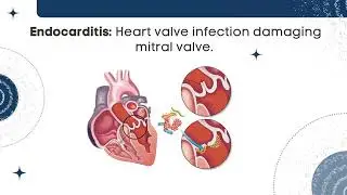 Mitral valve repair