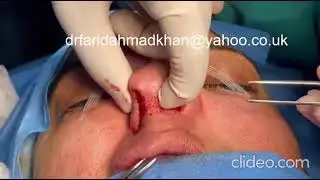 #nosejob#scarlesssurgery#nasalimplant