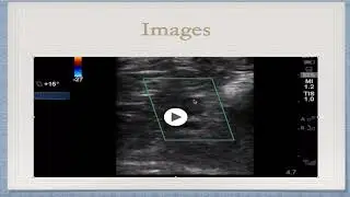 Brown EUS Case of the Month 12.17 DVT