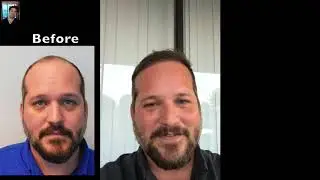 9 Months After Hair Transplant Surgery  | West Palm Beach Hair Transplant Results