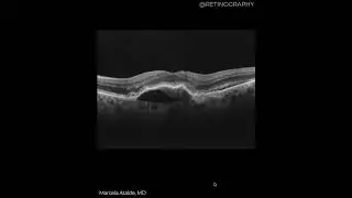 MACULAR NEOVASCULARIZATION TYPE 1 MULTIMODAL AND OCT BIOMARKERS ANALYSIS #retina #oftalmo #ophthalm