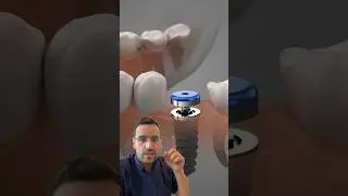 IMPLANT dentaire : AVANTAGES et CONTRE INDICATIONS