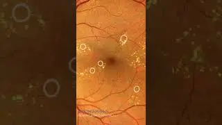 Diabetic retinopathy #retina #oftalmo #ophthalmology #oftalmologia #oftalmolog&iacute;a #ophtalmologie #о