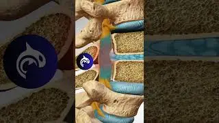 Lumbar Intervertebral Disc Herniation - 4K 3D Animation