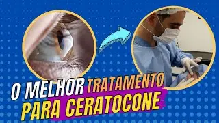 SOLU&Ccedil;&Atilde;O PARA CERATOCONE COMO &Eacute; FEITO O CROSSLINKING