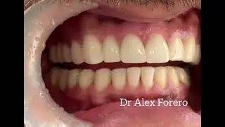 Dise&ntilde;o de Sonrisa en Colombia Dr Alex Forero 1
