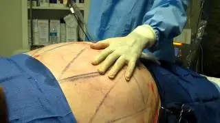 SmartLipo-Laser Liposuction-Orange County-Huntington Beach-Irvine-Long Beach-Westminister-Santa Ana