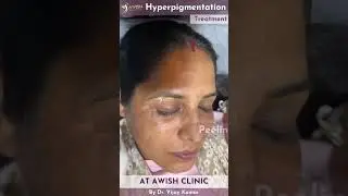 Peeling for hyperpigmentation treatments | Reduce pigmentation #pigmentation #hyperpigmentation