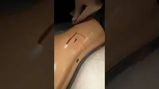 Sapheneous Vein Cut-down