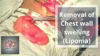 How to remove Lipoma from chest wall?
