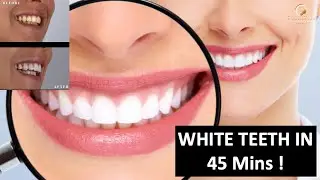 Teeth Whitening At The Dentist In Dubai | Fastest Way To Whiten Your Teeth