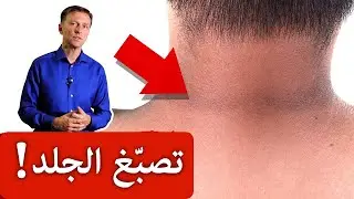 الحل لتصبغات الجلد في الرقبة وتحت الابط وأماكن أخرى!