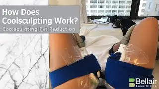 How does Coolsculpting body sculpting work?