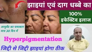 जिद्दी से जिद्दी Pigmentation/झाइयां,दागधब्बे होगा 100%ठीक इस चमत्कारिक इलाज से By Dr. Mustak Ansari