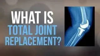 What is Total Joint Replacement? |  The Orthopedic Center of Palm Beach County