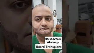 Beard Transplant Bangladesh | Beard Transplant 2000 Grafts #beardtransplant