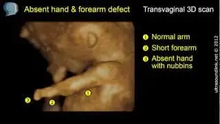 Limb reduction defect (meromelia) 3D scan