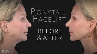 Ponytail Facelift - It's More Than A Name... More Than Just Plastic Surgery. It's My Life's Work.