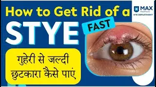 Home Remedies for Eye Stye in Hindi: Simple Tips for Quick Relief from Eye Infection