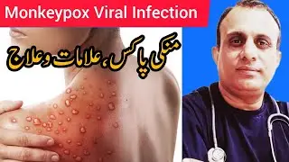Monkeypox | Causes | Symptoms | Homoeopathic Treatment