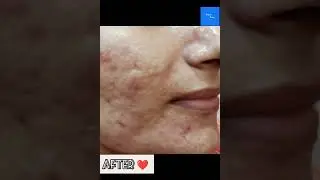 Anti acne treatment after and before result's #hydrafacial #acne #hydrafacial seram reviews
