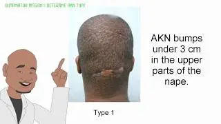 Bumpinator Surgical Wand For Permanently Terminating Back of Head Scars  Acne Keloidalis Nuchae AKN