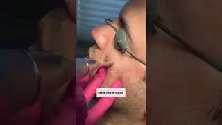 Pico Laser for Brown Spots #dermatology #picolaser