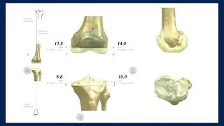Robotic-Assisted Knee Replacement | Jim Bowers, MD | Burlington, North Carolina
