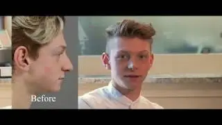 Male Septorhinoplasty Transformation with Long Island Facial Plastic Surgeon