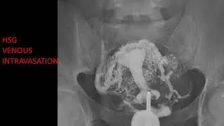 CASE 246 HSG VENOUS INTRAVASATION