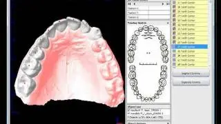 Virtual Tooth / Model Segmentation in OnyxCeph&sup3;